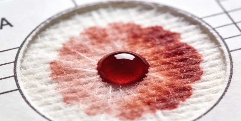 医生正在进行腹腔积液穿刺取样操