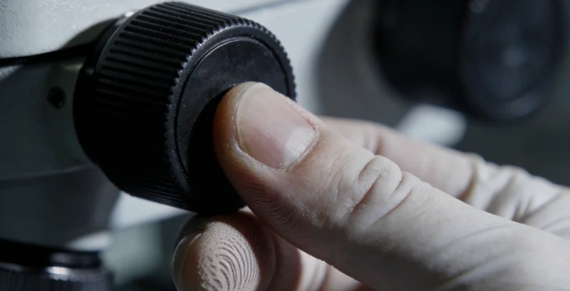 医生在显微镜下观察脑胶质瘤组织切片，旁边放着检测报告