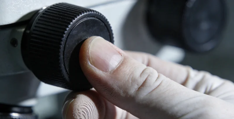 病理医生在显微镜下观察肉瘤组织切片