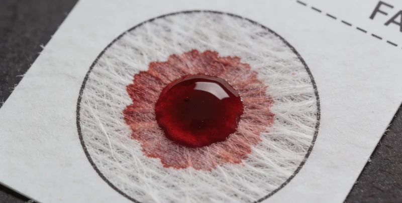 护士正在指导患者进行痰液样本采